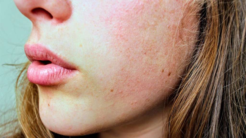 Acne emocional: como tratar