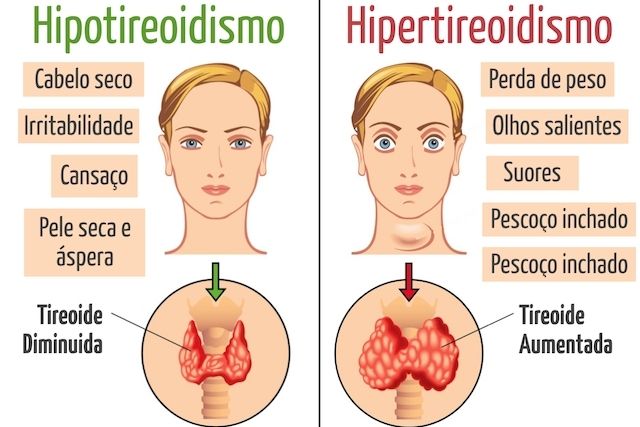 Hiper/Hipotireoidismo
