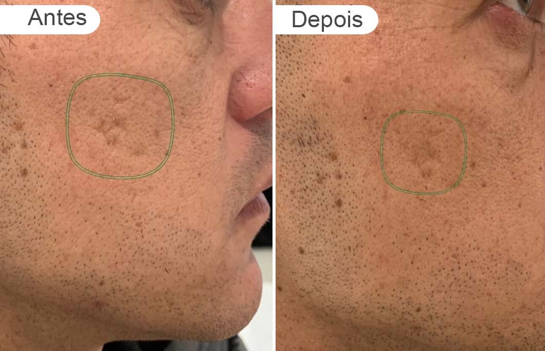 pagina resultados - antes e depois | Cicatrizes de acne, homem